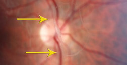 Lutein deficit - light spots