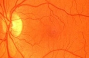 Retinal rupture after Optivision