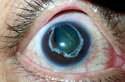 Cataract before Optivision